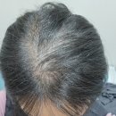 대우하얀세탁 | 천연 헤나로 원형 탈모 효과본 청천동 클레오 헤어 미용실