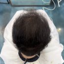 제주아티스트 | 제주 탈모“모자 벗기 싫다던 고객님, 거울 보고 웃으셨어요” 제주 링거펌 후기
