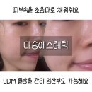 [고양피부관리] 임산부도 가능한 LDM 물방울 리프팅 체험 – 다솜에스테틱 화정점 후기