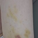 [평택에스테틱] 3주 패키지 팔뚝관리 후기, 선새김에스테틱