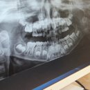 아이 첫니 발치 후기 흔들리는 유치, 언제 뽑아야 할까? 치과 X-ray 검진 및 첫니 뺏어요.