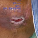 무의식와상환자 엉덩이욕창4기 이미지