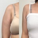 지방 | 수원 팔뚝 지방추출주사후기 3개월 총정리(가격,부작용,후관리,탄력)