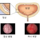 간질성 방광염 증상 원인 통증 치료 방법 이미지