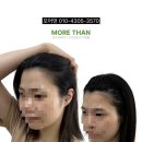 모어댄SMP | 대구 헤어라인 커버 내돈내산 후기 좋은곳 모어댄