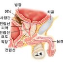 전립선암 이미지