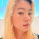 팔자주름과 눈 밑 인디언밴드 고민 꼼꼼한 비에이한의원 상담 끝에 선택한 젬버시술 피팅레이저...