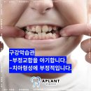 에이플란트치과의원 네이버블로그