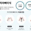 맨하탄치과기공소 네이버블로그