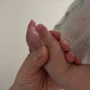 16개월아기 손가락 밥솥 증기화상, 표재성 2도화상, 치료기간, 인천 화상전문병원 (구월동 정담외과)