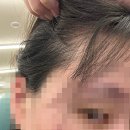 아너스의원 | 창원아너스의원 지루성 두피염 치료후기 1탄!!