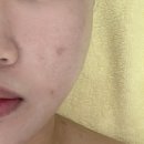 지에스25 영등포아크로점 | 영등포시장역 에스테틱 영등포 여드름관리 재생관리 후기 : 온테라피