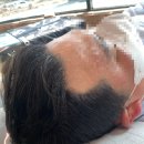 구미두피문신 탈모를 극복하다