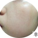 바이오에스 네이버블로그