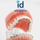 위례교정치과 아이디문정치과 설측교정발음 문제 없어요