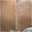 모광 | [천안 피부관리] 남자 모공관리 브이라인천안점 남편 모공관리 첫 후기