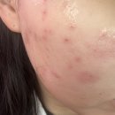 신월큰길 | 순천 임주영피부과 편평사마귀 레이저 시술 후기 및 관리 방법