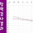 스타키보청기 이미지