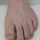 지족역 | 대전 노은동 지족역 발톱무좀 대만족 관리 후기 열개의손가락 닥터아이티엔 대전유성구점