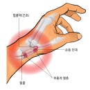 신근열 | 드퀘르벵 건초염 대처과정