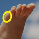 여기통증통풍증상일수있나요? 이미지