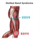 장경골띠증후군(iliotibial band syndrome), 장경인대증후군 이미지