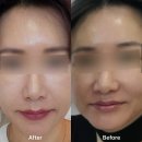 대구 경산 구미 인디언밴드 필러 중앙로역의원 만족 후기