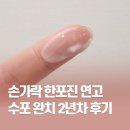수포차 | 손가락 한포진 연고 수포 완치 2년차 후기
