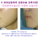 대구안면윤곽 사진-주걱턱 수술사진[대구성형외과,대구보톡스,대구고톡스,대구지방이식] 이미지