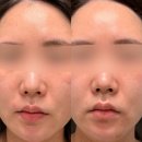 연세팜스의원 | ✨#1. 광주 프락셀 연세팜스의원 내돈내산 후기✨