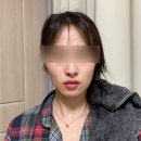 볼륨 | 강남역피부과 추천 쥬베룩 볼륨 후기 옆볼꺼짐 시술