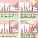 매복사랑니 발치 후기 (평택 굿모닝병원 치과) feat. 워싱턴치과