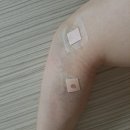 꽃돼지실비 | 테니스 엘보 완치 후기(치료방법 및 후유증)