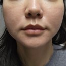 박성배피부과의원 | 미금역피부과 포텐자효과 내돈내산후기