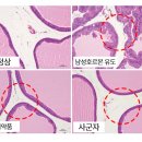 63세 남자, 수술없이 전립선비대증 완치법 공개 (배뇨장애+남성기능 개선까지, 제발 돈낭비 하지마세요) 이미지