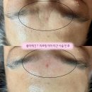 제기46 | 온정에스테틱 플라제긴 T 리프팅 후기!