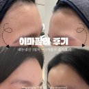 퉁이네 | 부산 이마필러 내돈내산 솔직후기 | 1일차부터 3개월차까지 (붓기, 통증, 유지력)