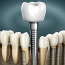 미소더예쁨치과의원 | 수원시 권선구 임플란트 치과 잘하는 곳, 가격 비용 싼 곳 BEST10 추천