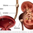 pyonephrosis in setting of proximal ureteral stone 이미지