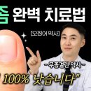 발톱무좀 완치법, 이 순서만 지키면 끝납니다, 약사가 알려주는 발톱무좀 완벽 정리 (feat. 레이저는 필수 아님) 이미지