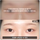 드림업성형외과의원 | 광주쌍수 후기 자연스러운 변화가 필요할때