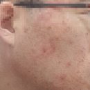접촉성 피부염, 모낭염 완전 치료 후 실비보험 청구도 해본 찐 후기(실비보험 청구를 위한 질병코드번호)