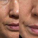 모공 순삭 리얼 콜라겐 치크팩 후기