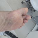 레푸스구미산동점 | 발톱무좀으로 2년만에 다시 찾게 된 레푸스 구미산동점