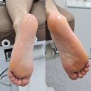 역곡신발 | 부천 역곡 [페디프로] 남자 문제성발관리 무좀 발톱스케일링 발각질제거