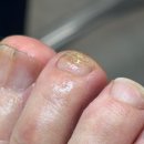 레푸스동래 | 부산 동래 굳은살 내성발톱 무좀전문 레푸스 부산동래역점 방문후기