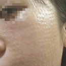 창원유앤미치과의원 | ✨️내돈내산✨️ 진해 피부과 리쥬란HB 1회차 후기 (이벤트, 통증, 전후사진 근접샷, 꿀팁)