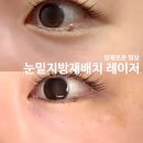 더이노써클 | 다크서클 해결 눈밑지방재배치 레이저 올인원 루엘프팅