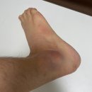 감초탕 | 발목인대염증 방치하면 만성 돼요! 거장탕크림으로 손상 관리 후기