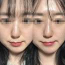 압구정-224 | 강남 코실리프팅 &lt; 압구정 뷰리플한의원 &gt; 요즘 핫한 맘에 쏙 드는 코프팅 후기